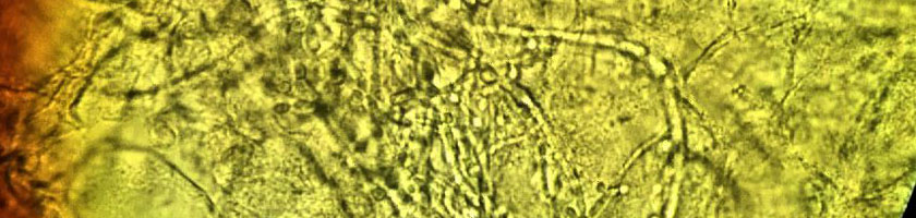 candida-minhistorie-06-banner-vagina-wet-mount-of-candida-vulvovaginitis